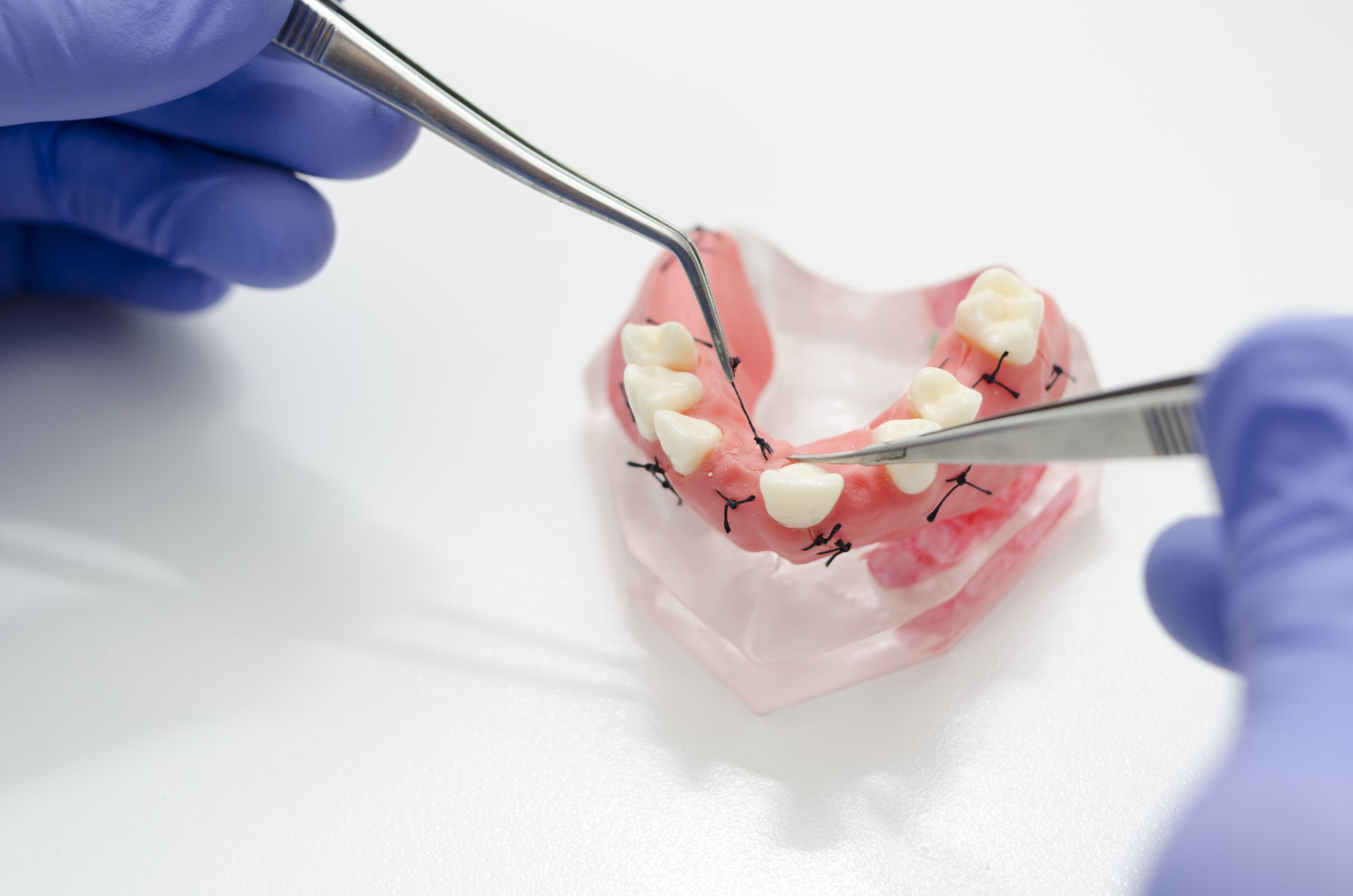 Dental Sutures: Procedure, Care And Benefits